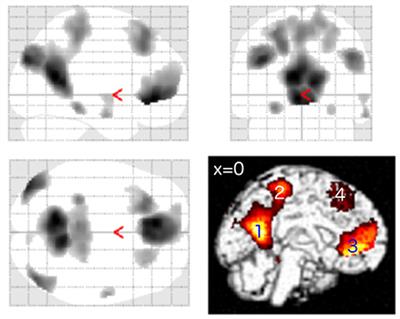 Heidelberg Neuro-Music Therapy Enhances Task-Negative Activity in Tinnitus Patients
